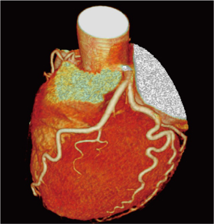 正常の冠動脈(VR像)の画像