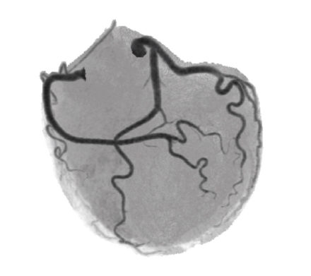 正常の冠動脈(アンギオグラフィックビュー)の画像