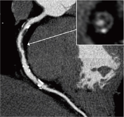 右冠動脈プラークの画像