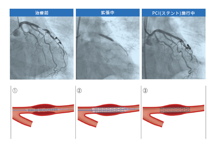 冠動脈ステント留置(カルーテル治療)の画像