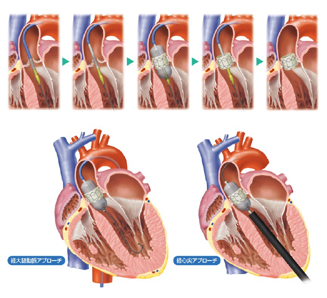 経カテーテル的大動脈弁置換術(TAVI)の画像